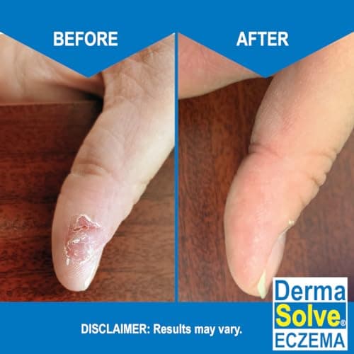 Dermasolve Eczema Relief Body Wash (2 Pack) | Protects, Moisturizes, and Repairs Skin - Kids, Babies & Adults - Steroid Free - Image 4