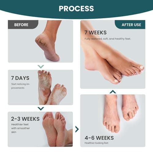 Aifufand Pedicure Foot Care Kit 3 Piece – Includes Ginger Foot Spray, Callus Remover & Moisturizing Anti Crack Cream Stick, Care Kit for Women & Men, Perfect for Dry Cracked Feet - Image 7