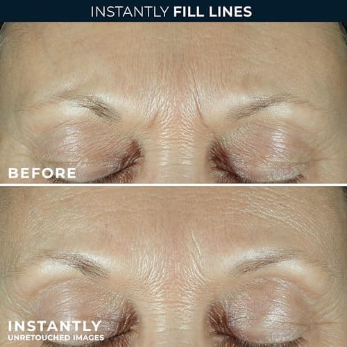 RoC Derm Correxion Fill + Treat Advanced Retinol Serum, Wrinkle Filler Treatment with Hyaluronic Acid for Crow's Feet, 11 Wrinkles, & Laugh Lines, (.5 fl oz) with Retinol Packette (Packaging May Vary) - Image 4