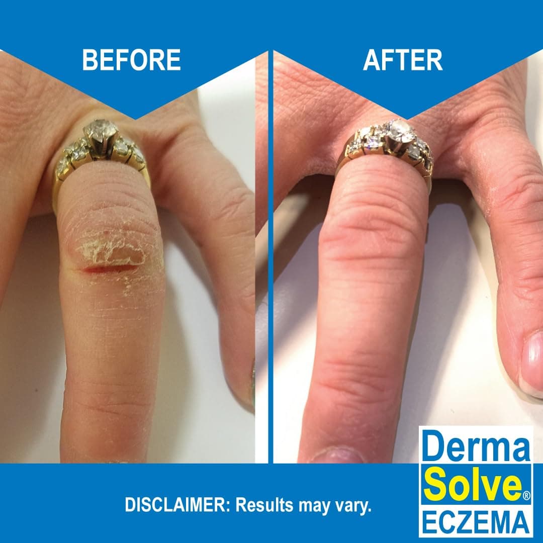 Dermasolve Eczema Relief Body Wash (2 Pack) | Protects, Moisturizes, and Repairs Skin - Kids, Babies & Adults - Steroid Free - Image 4