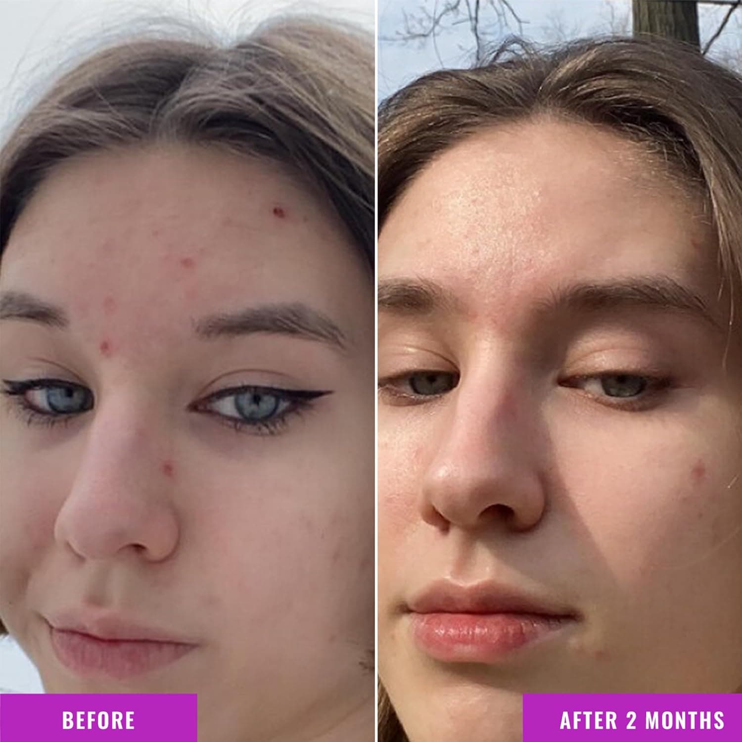 Good Molecules Niacinamide Serum - 10% Niacinamide to Target Acne, Nourishment, and Skin Tone - Ultra Hydrating Serum and Brightening Skin Care for Face 2.53 Fl Oz (Pack of 1) - Image 5