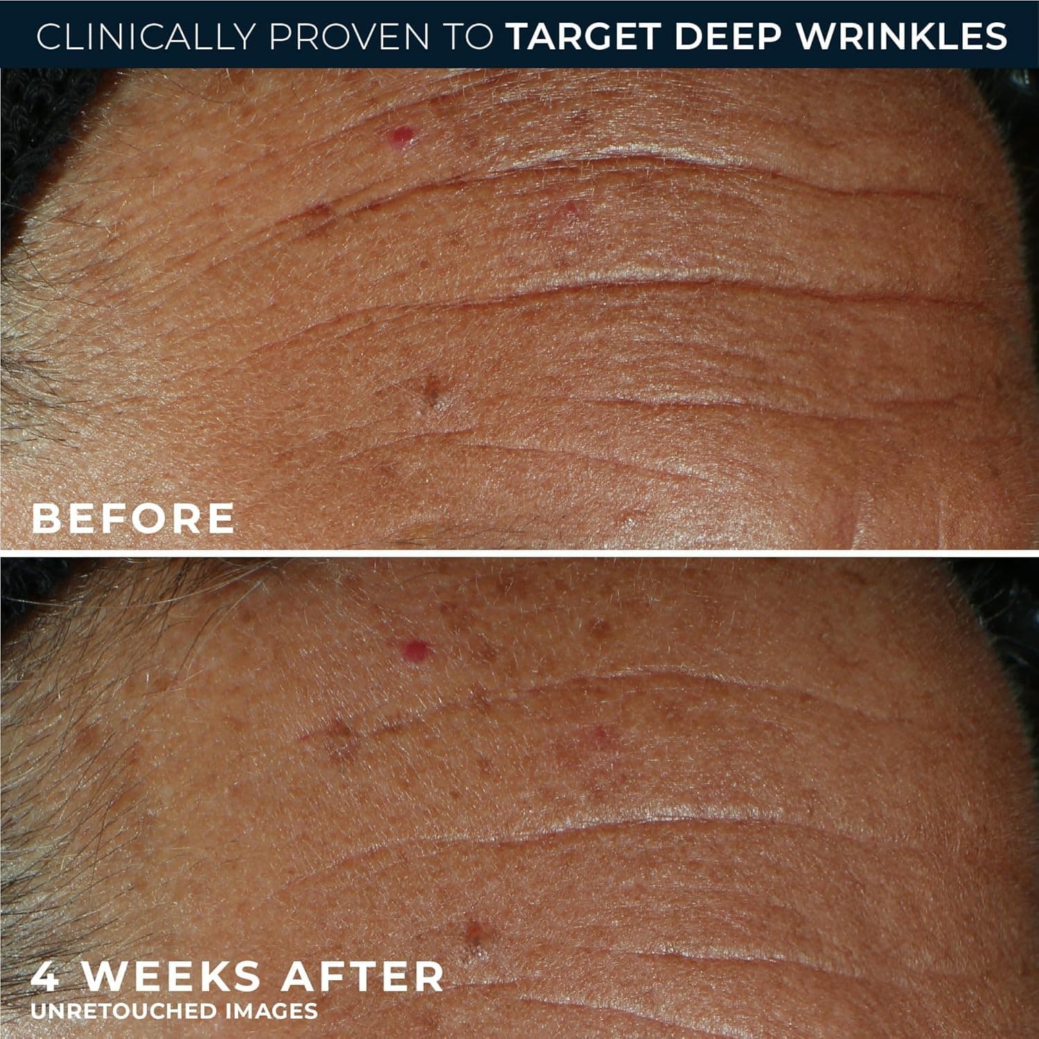 RoC Derm Correxion Fill + Treat Advanced Retinol Serum, Wrinkle Filler Treatment with Hyaluronic Acid for Crow's Feet, 11 Wrinkles, & Laugh Lines, (.5 fl oz) with Retinol Packette (Packaging May Vary) - Image 7