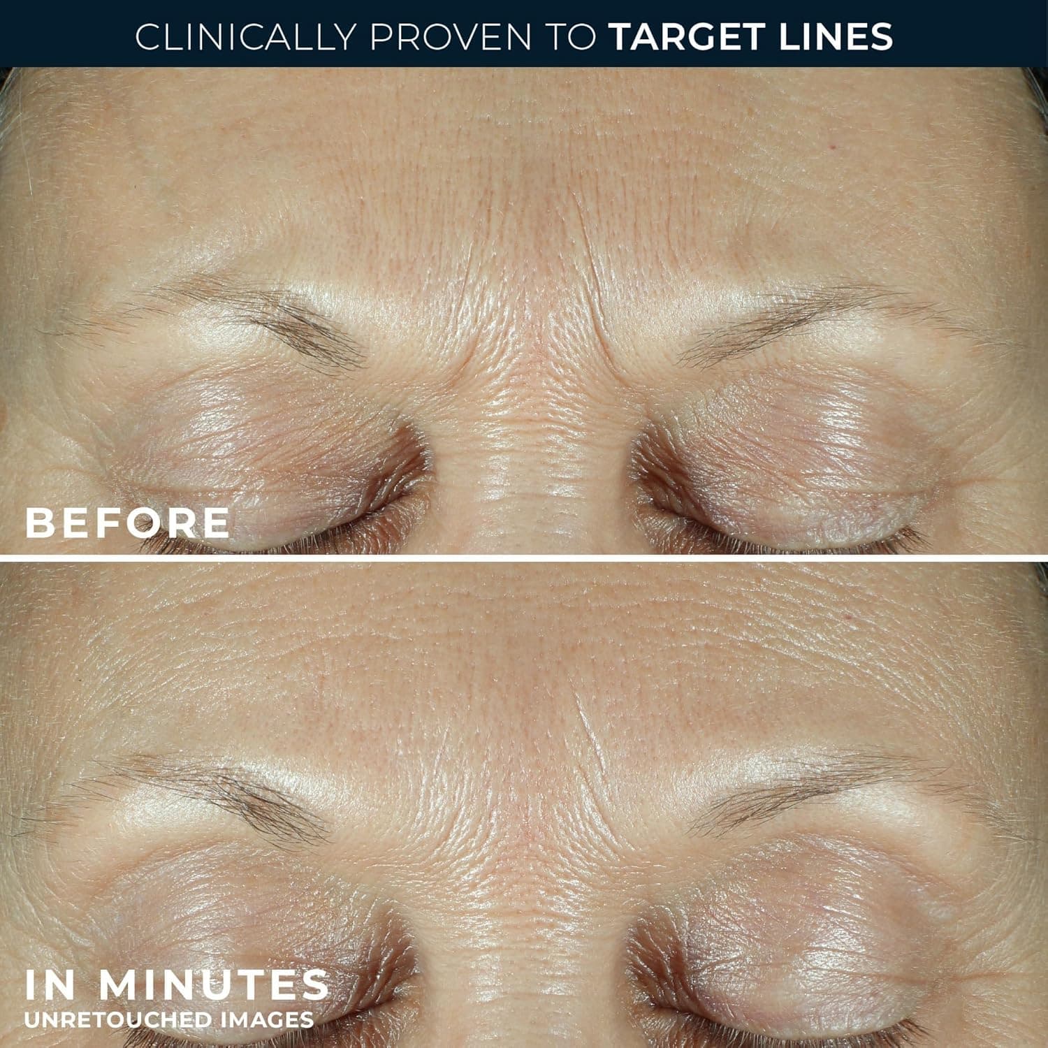 RoC Derm Correxion Fill + Treat Advanced Retinol Serum, Wrinkle Filler Treatment with Hyaluronic Acid for Crow's Feet, 11 Wrinkles, & Laugh Lines, (.5 fl oz) with Retinol Packette (Packaging May Vary) - Image 6